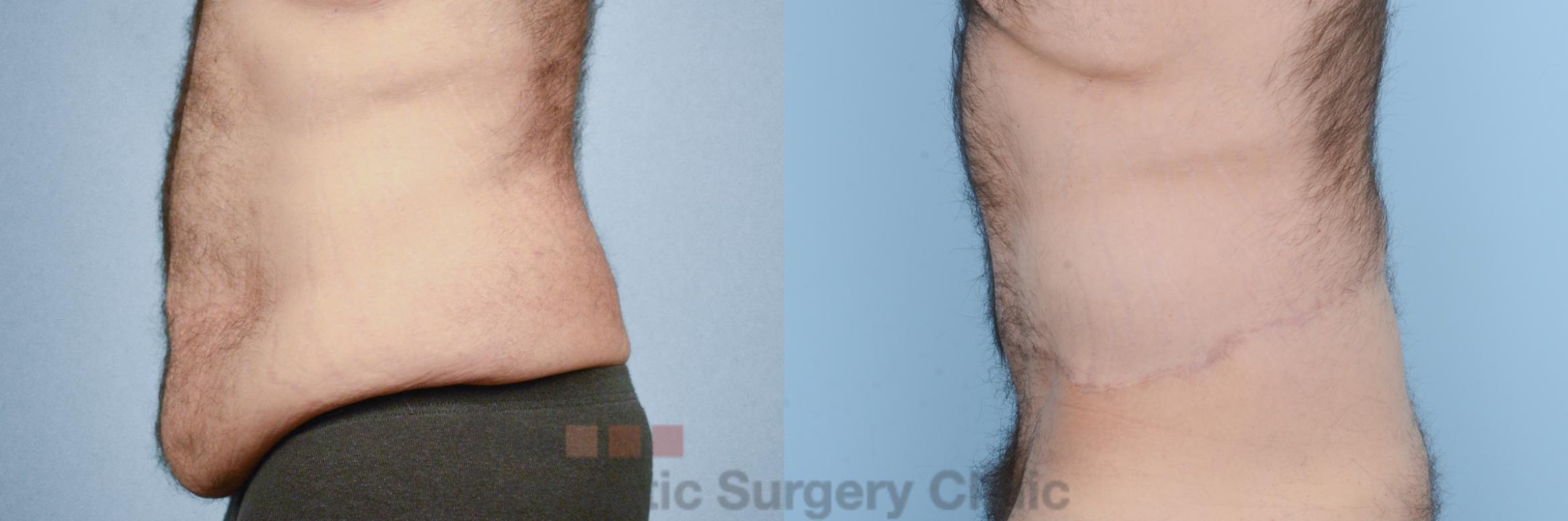 Before & After Body Lift Case 218 View #1 View in Waterloo, Ontario