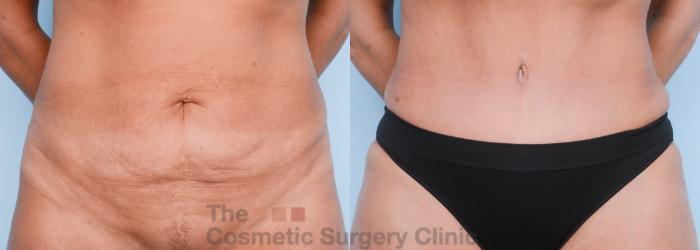 Before & After Body Lift Case 566 View #1 View in Waterloo, Ontario