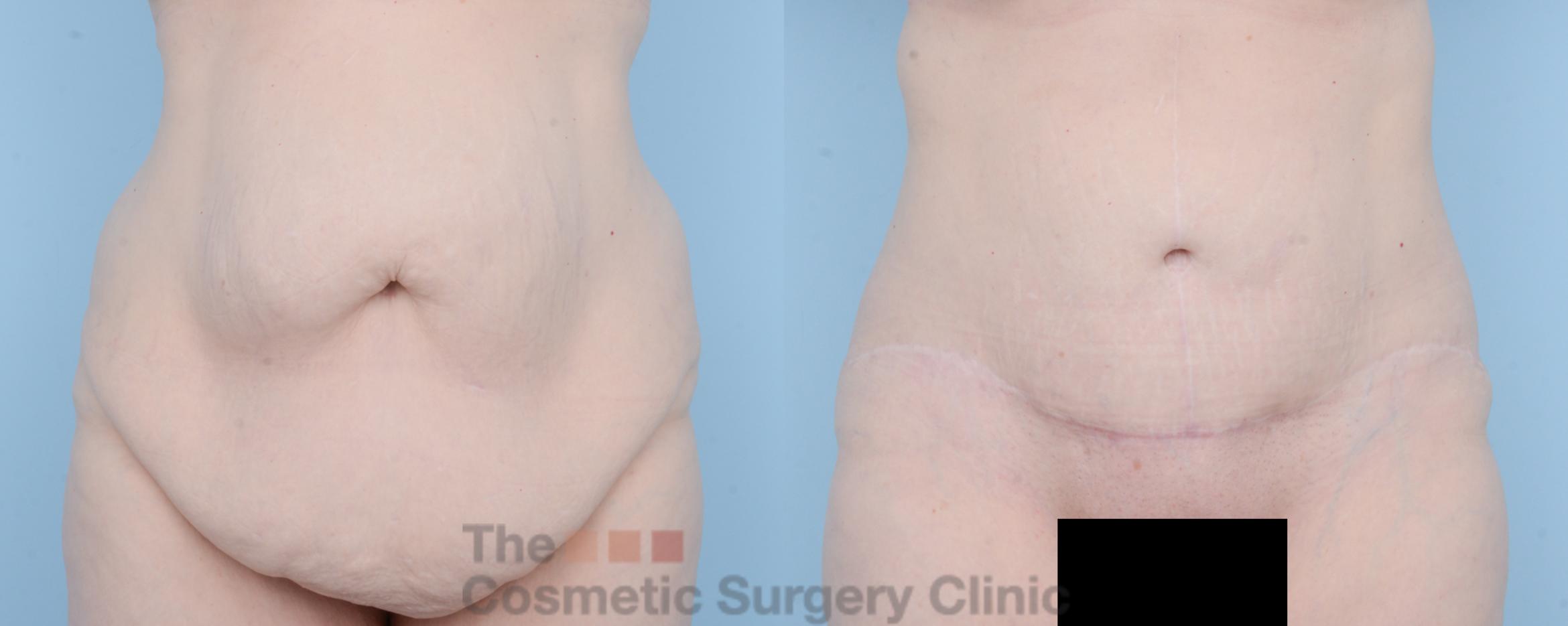 Before & After Body Lift Case 625 View #1 View in Waterloo, Ontario