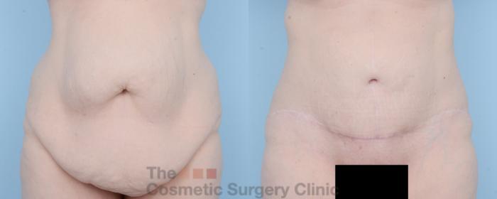 Before & After Body Lift Case 625 View #1 View in Waterloo, Ontario