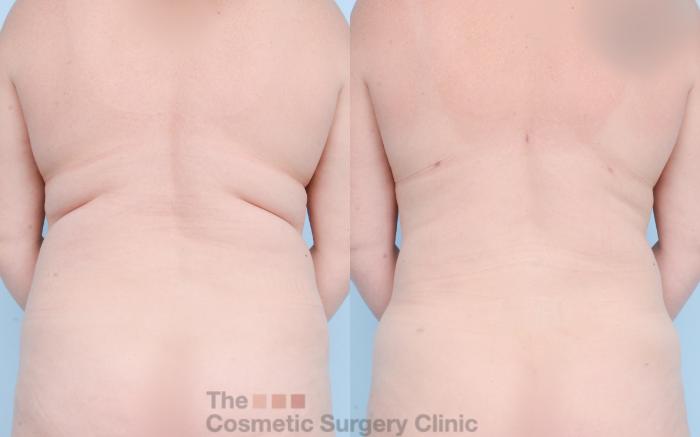 Before & After Liposuction Case 841 Back View in Waterloo, Ontario