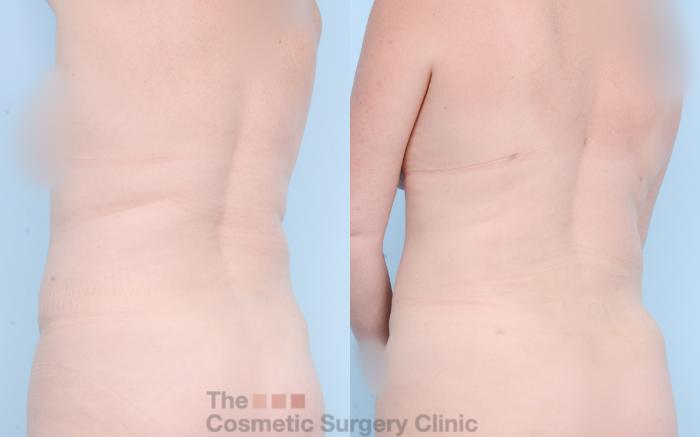 Before & After Liposuction Case 841 Left Back Oblique View in Waterloo, Ontario