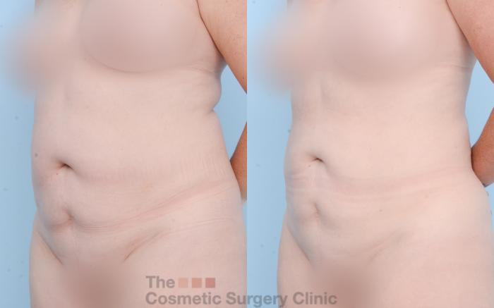 Before & After Liposuction Case 841 Left Oblique View in Waterloo, Ontario