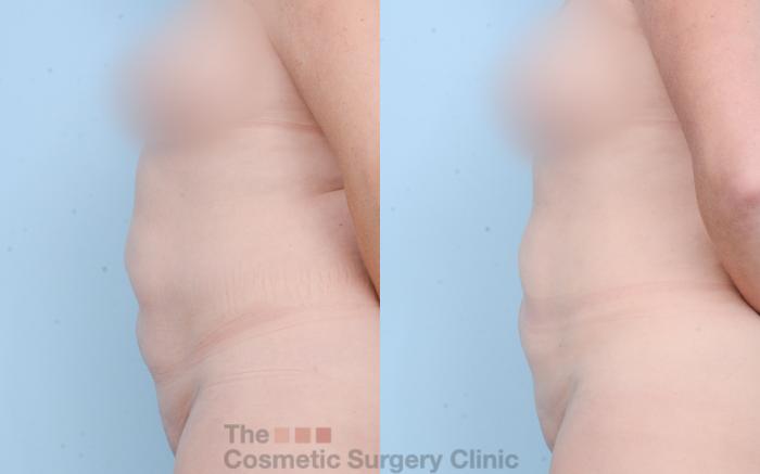 Before & After Liposuction Case 841 Left Side View in Waterloo, Ontario