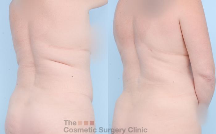 Before & After Liposuction Case 841 Right Back Oblique View in Waterloo, Ontario