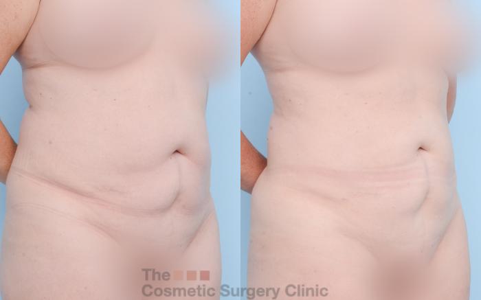Before & After Liposuction Case 841 Right Oblique View in Waterloo, Ontario