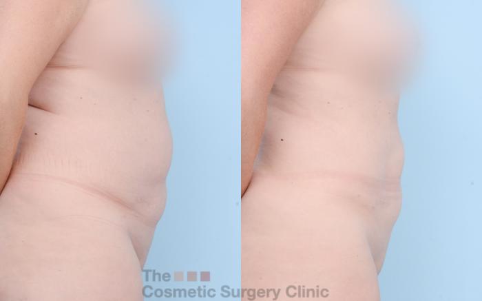 Before & After Liposuction Case 841 Right Side View in Waterloo, Ontario