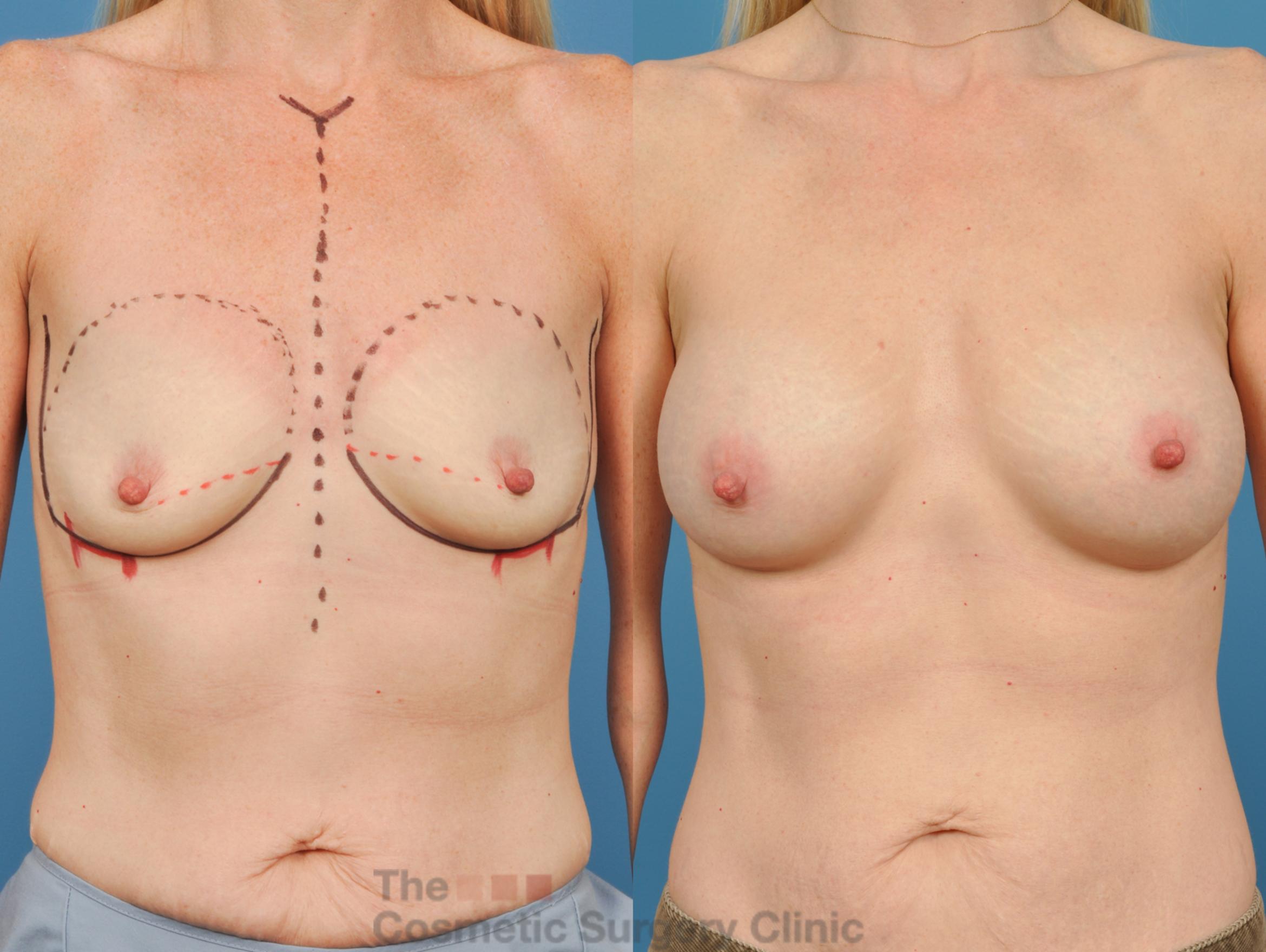 Before & After Breast Augmentation Case 143 View #1 View in Waterloo, Ontario