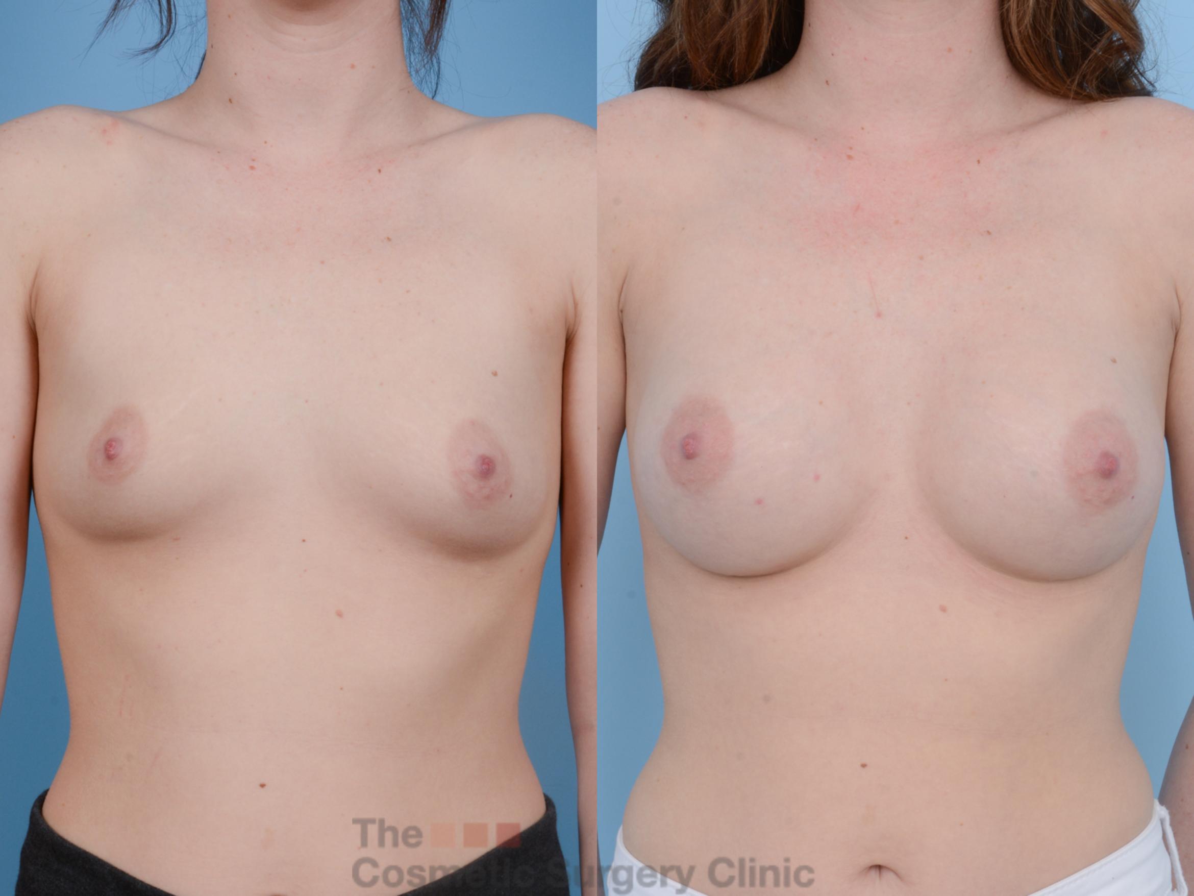 Before & After Breast Augmentation Case 157 View #1 View in Waterloo, Ontario
