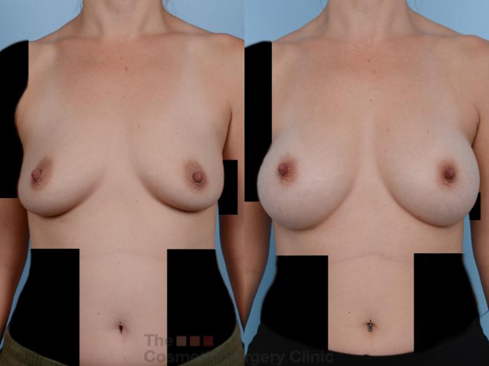 Before & After Breast Augmentation Case 244 View #1 View in Waterloo, Ontario