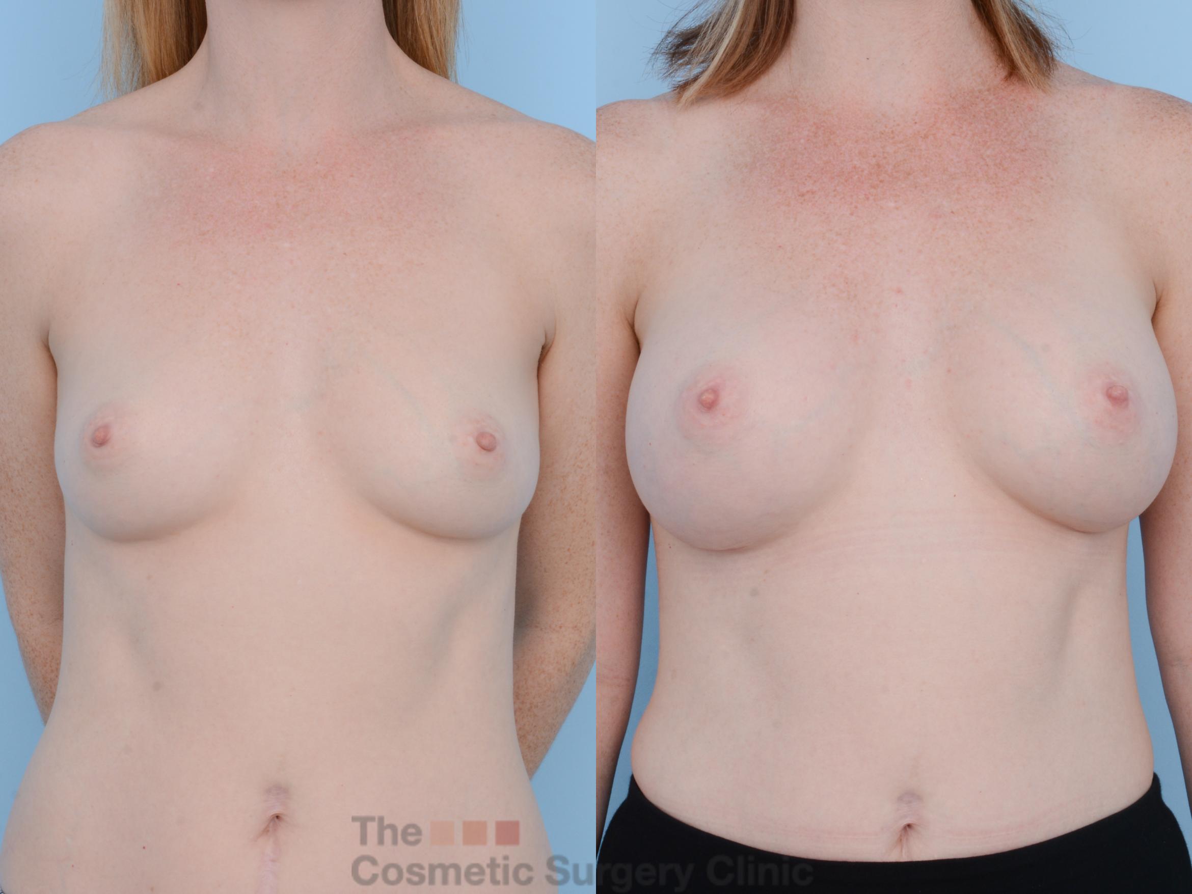 Before & After Breast Augmentation Case 319 View #1 View in Waterloo, Ontario