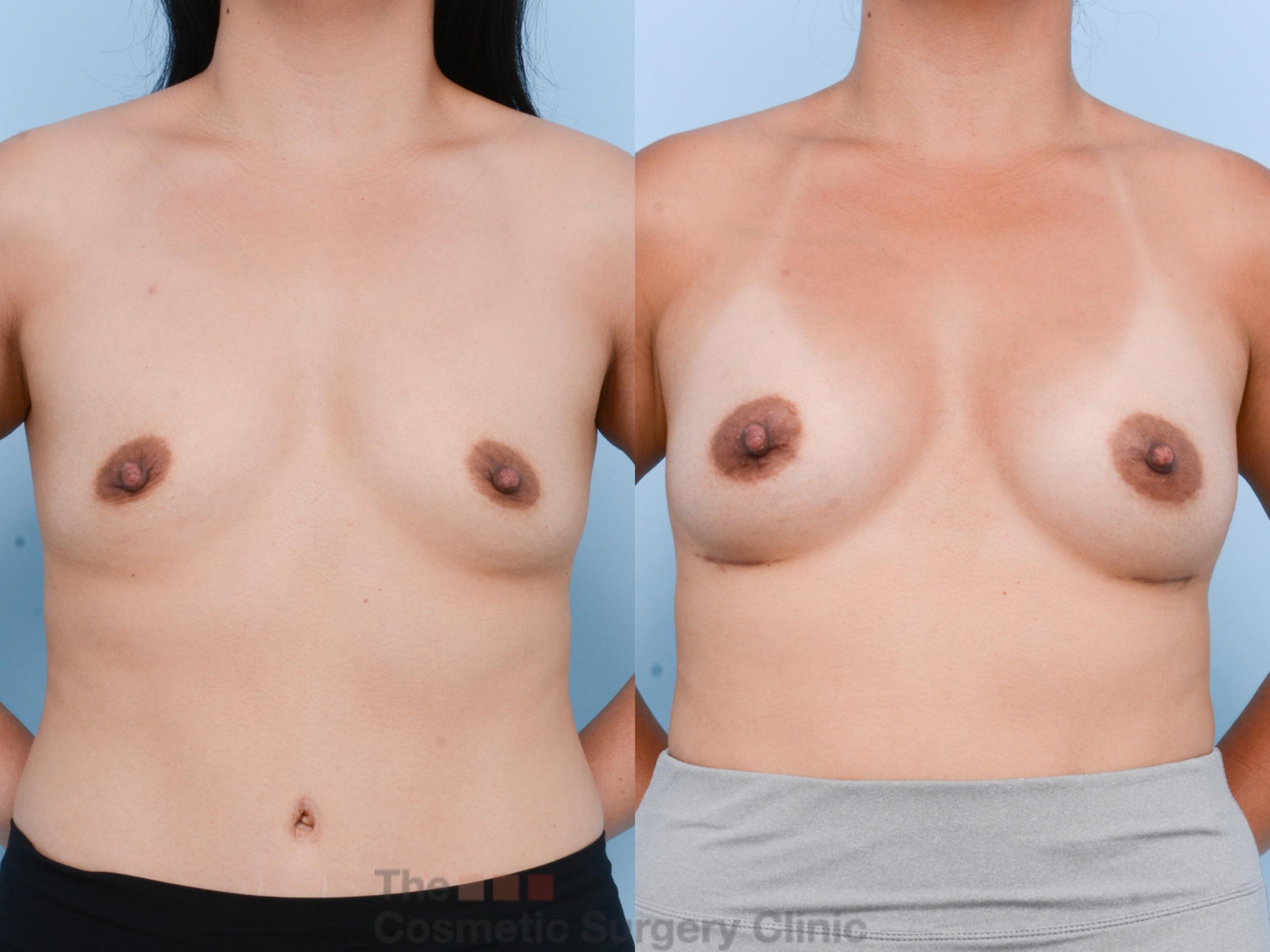 Before & After Breast Augmentation Case 606 View #1 View in Waterloo, Ontario