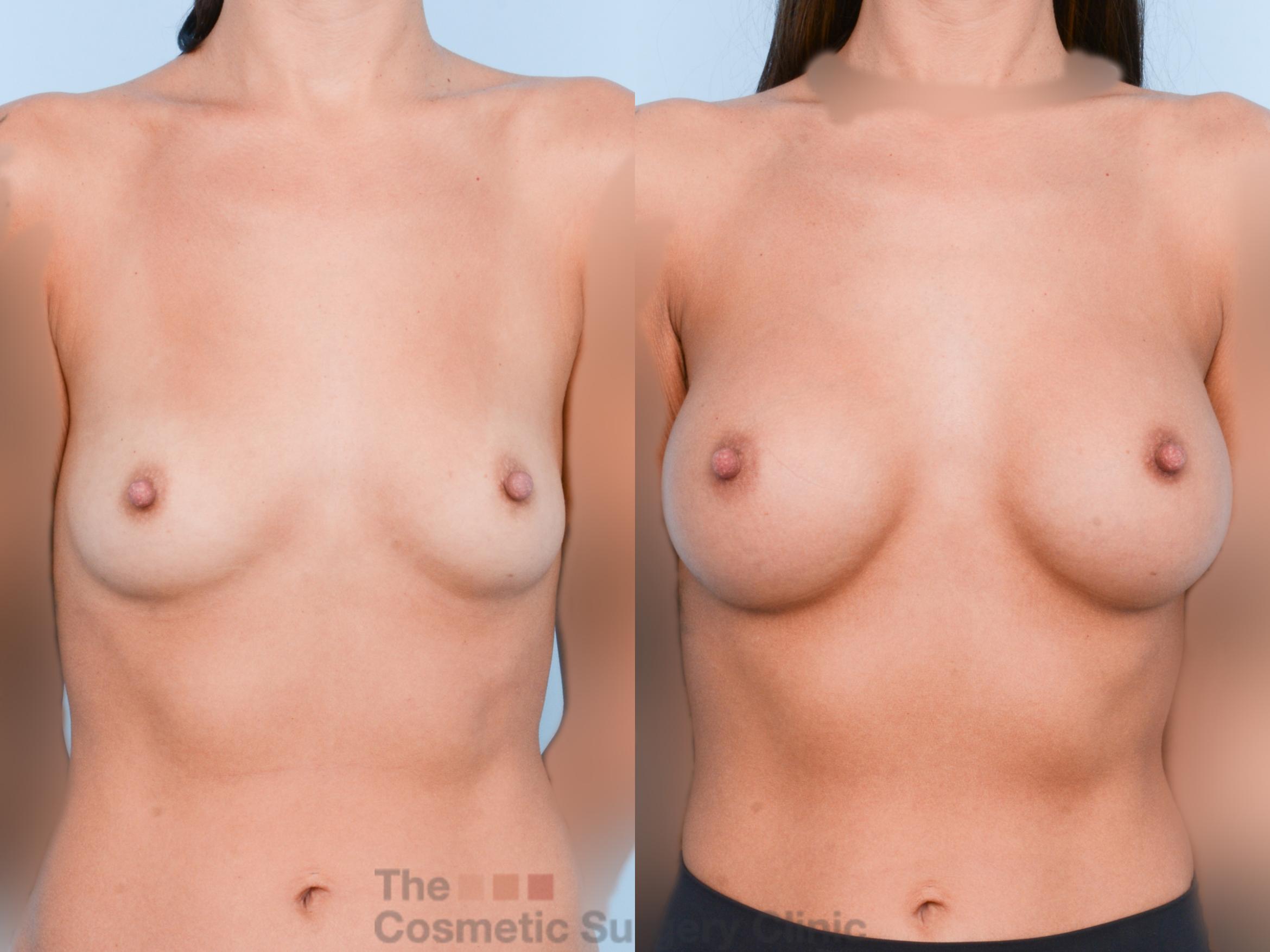 Before & After Breast Augmentation Case 764 Front View in Waterloo, Ontario