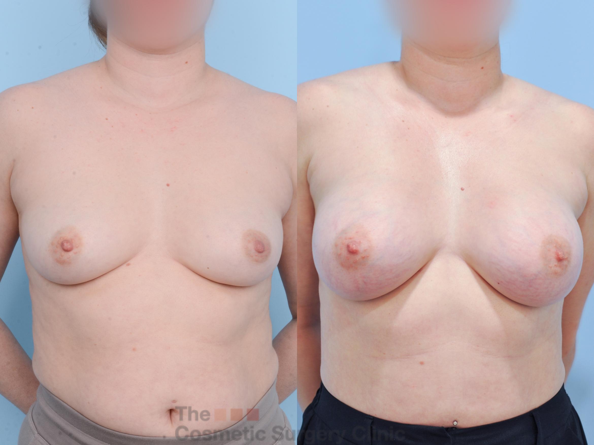 Before & After Breast Augmentation Case 820 Front View in Waterloo, Ontario