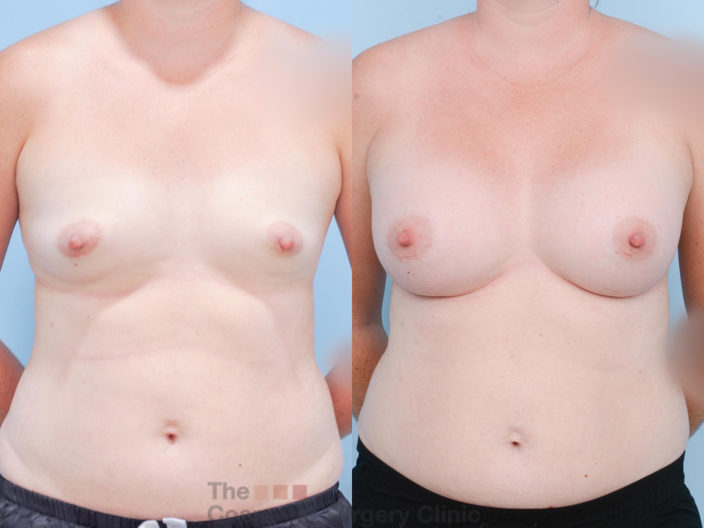 Before & After Breast Augmentation Case 844 Front View in Waterloo, Ontario