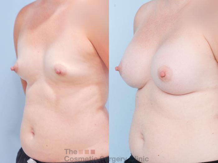 Before & After Breast Augmentation Case 844 Left Oblique View in Waterloo, Ontario