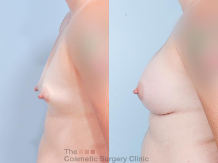 Before & After Breast Augmentation Case 844 Left Side View in Waterloo, Ontario