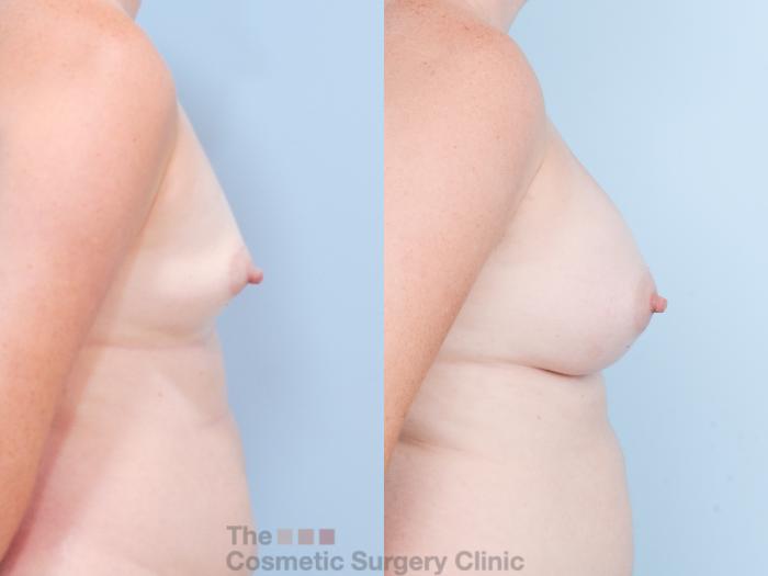 Before & After Breast Augmentation Case 844 Right Side View in Waterloo, Ontario