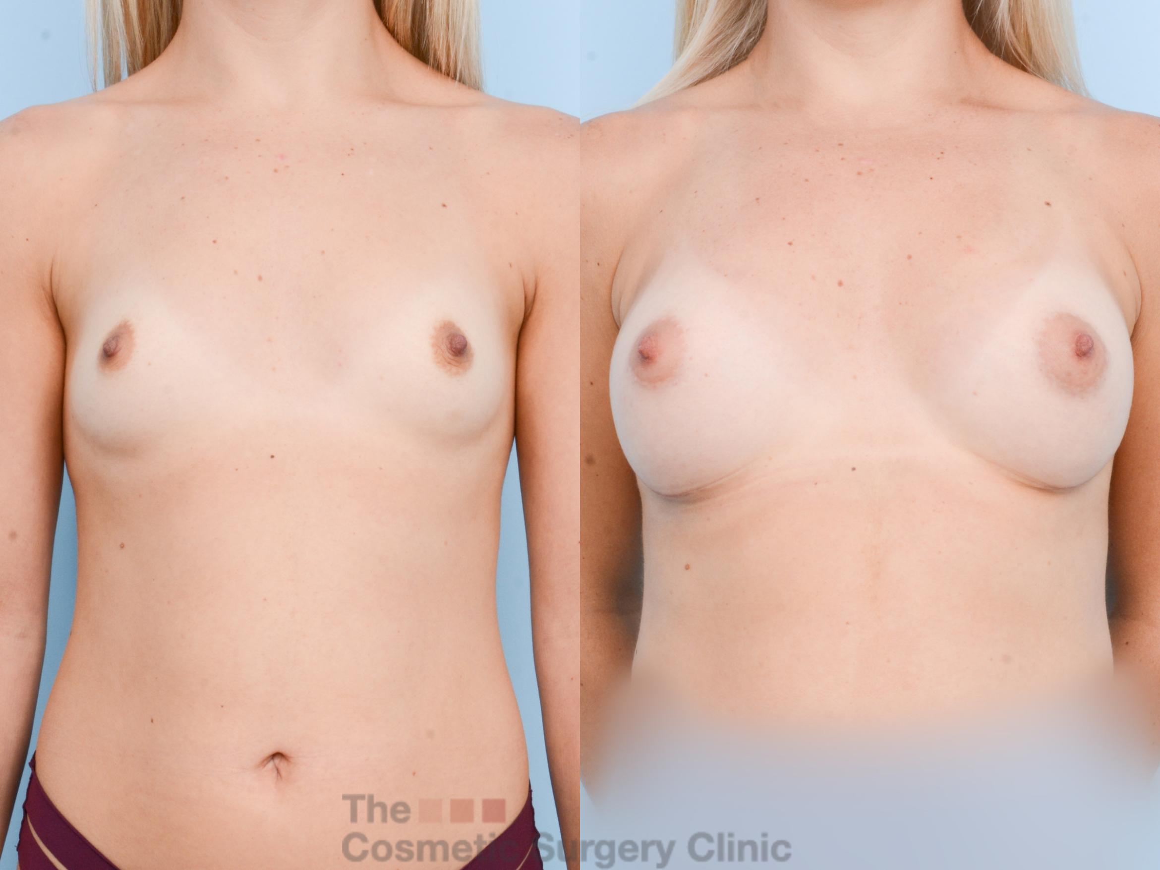 Before & After Breast Augmentation with Fat Grafting Case 801 Front View in Waterloo, Ontario