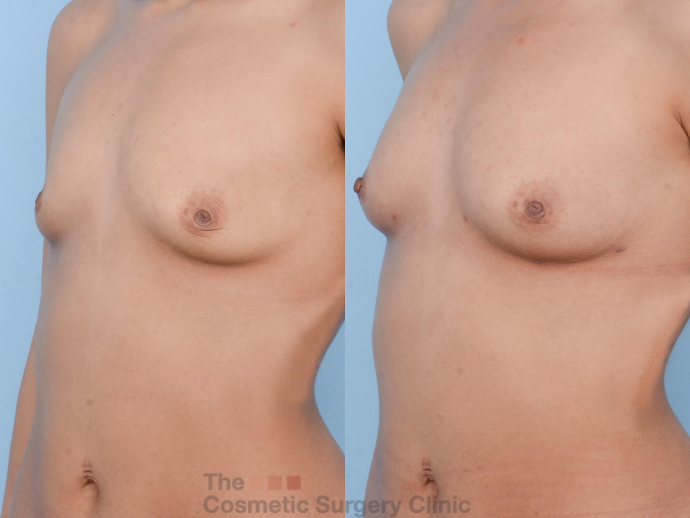 Before & After Breast Fat Grafting (No Implant) Case 402 View #1 View in Waterloo, Ontario
