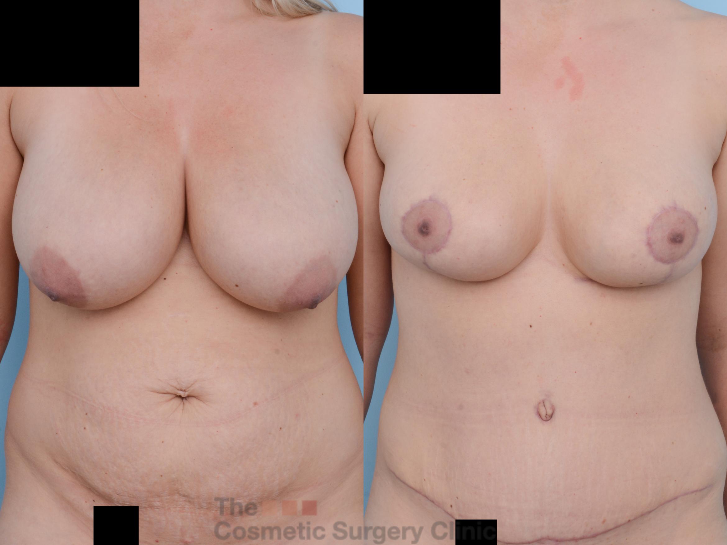 Before & After Breast Reduction Case 280 View #1 View in Waterloo, Ontario