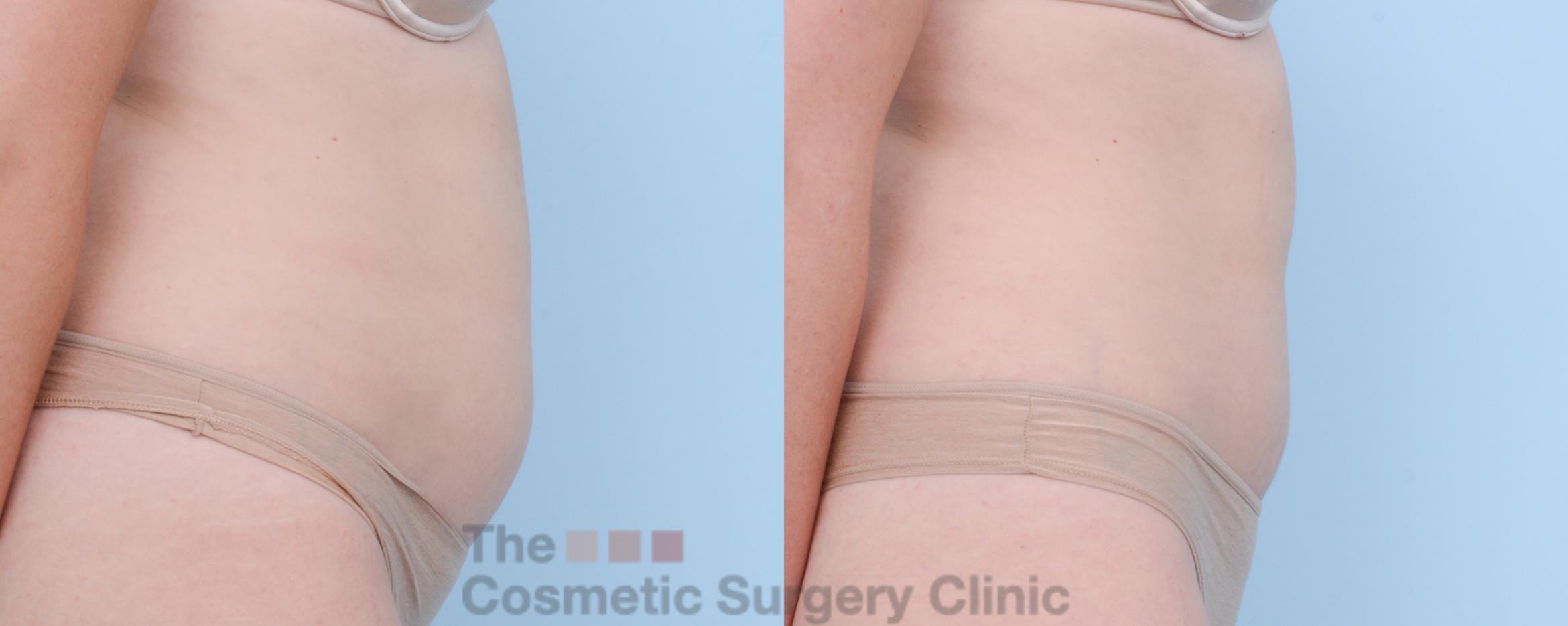 Before & After CoolSculpting Case 403 View #1 View in Waterloo, Ontario