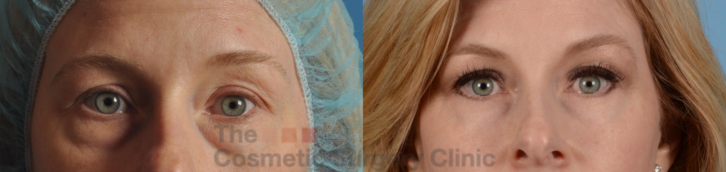 Before & After Eyelid Lift Case 119 View #1 View in Waterloo, Ontario