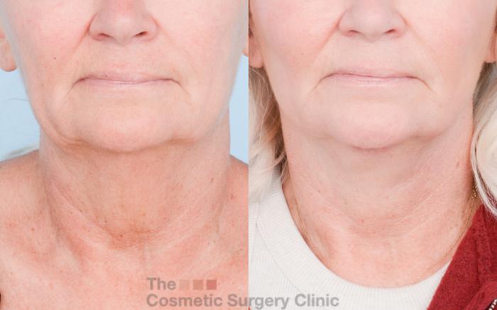 Before & After Facelift Case 852 Front View in Waterloo, Ontario