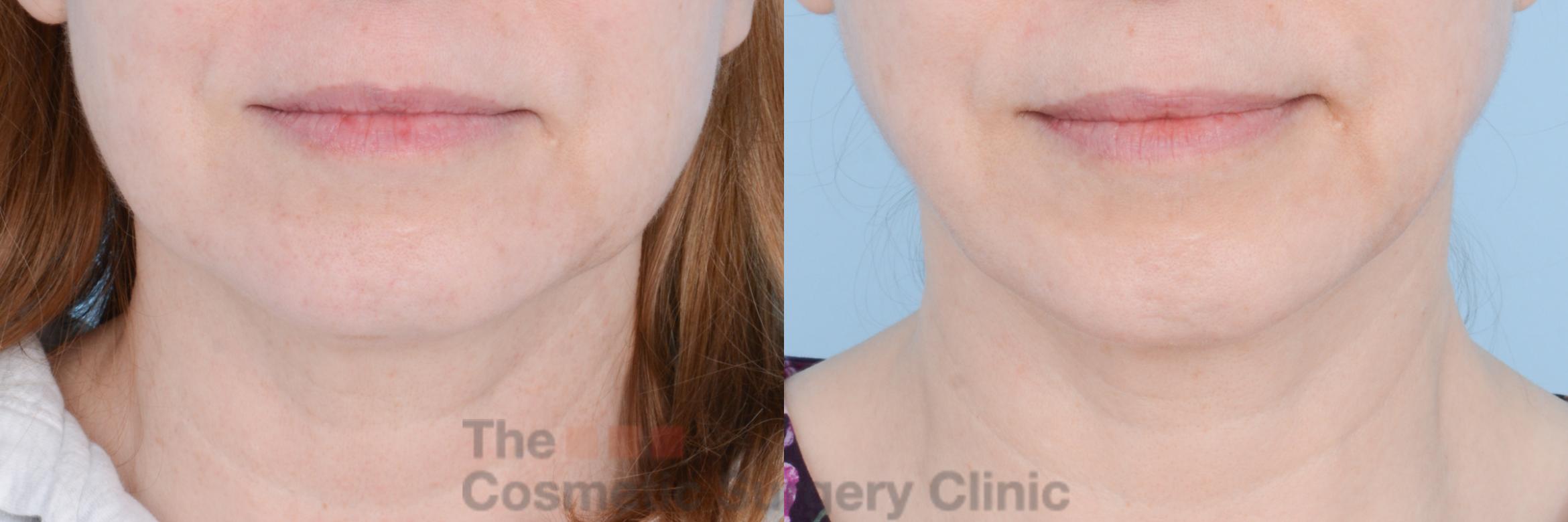 Before & After FaceTite Case 598 View #1 View in Waterloo, Ontario