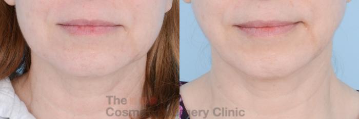 Before & After FaceTite Case 598 View #1 View in Waterloo, Ontario