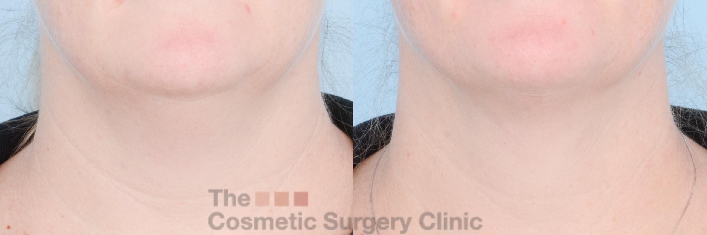 Before & After FaceTite Case 842 Front View in Waterloo, Ontario