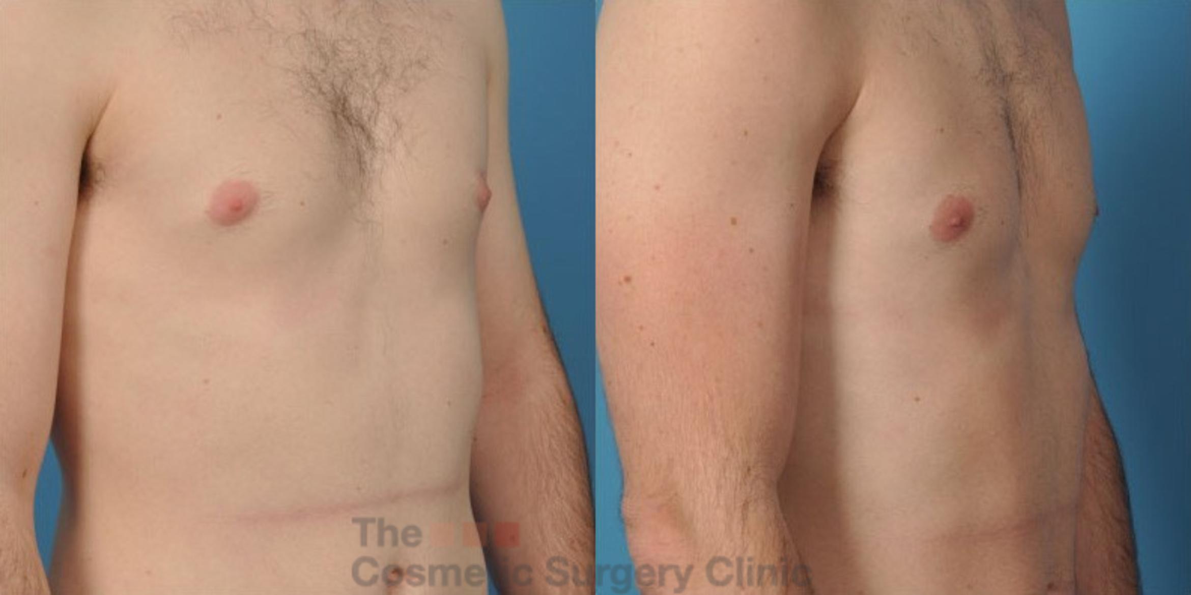 Before & After Male Breast Reduction / Gynecomastia Case 36 View #1 View in Waterloo, Ontario