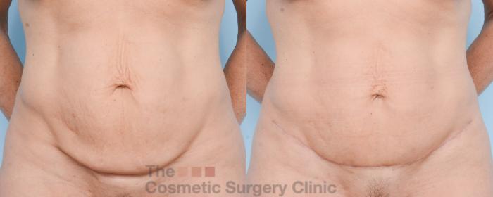 Before & After Mini-Tummy Tuck Case 803 Front View in Waterloo, Ontario