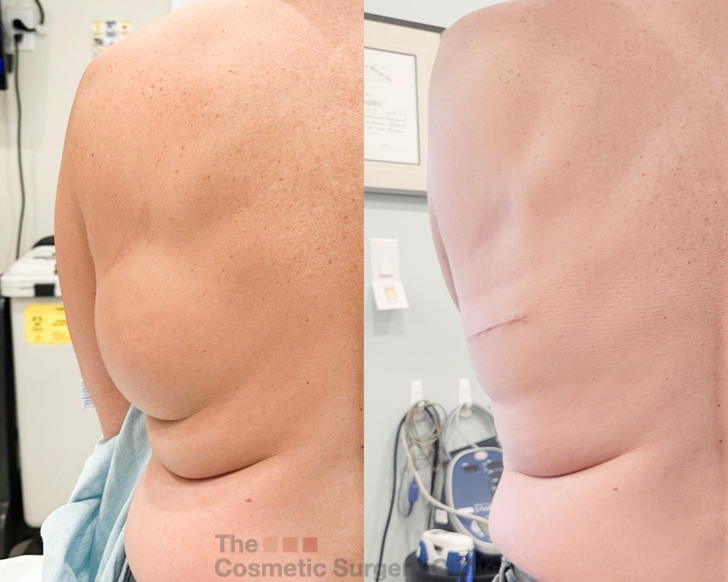 Before & After Mole & Lesion Removal Case 819 Back View in Waterloo, Ontario