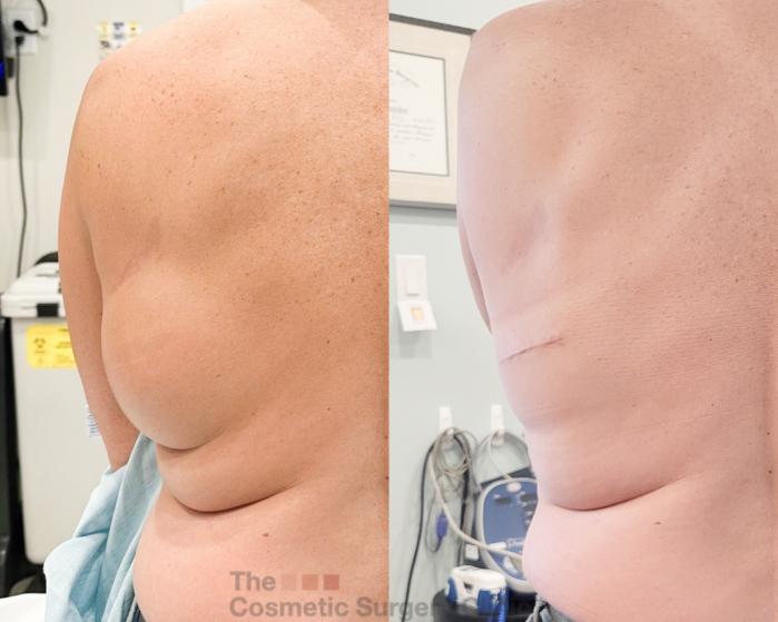 Before & After Mole & Lesion Removal Case 819 Back View in Waterloo, Ontario
