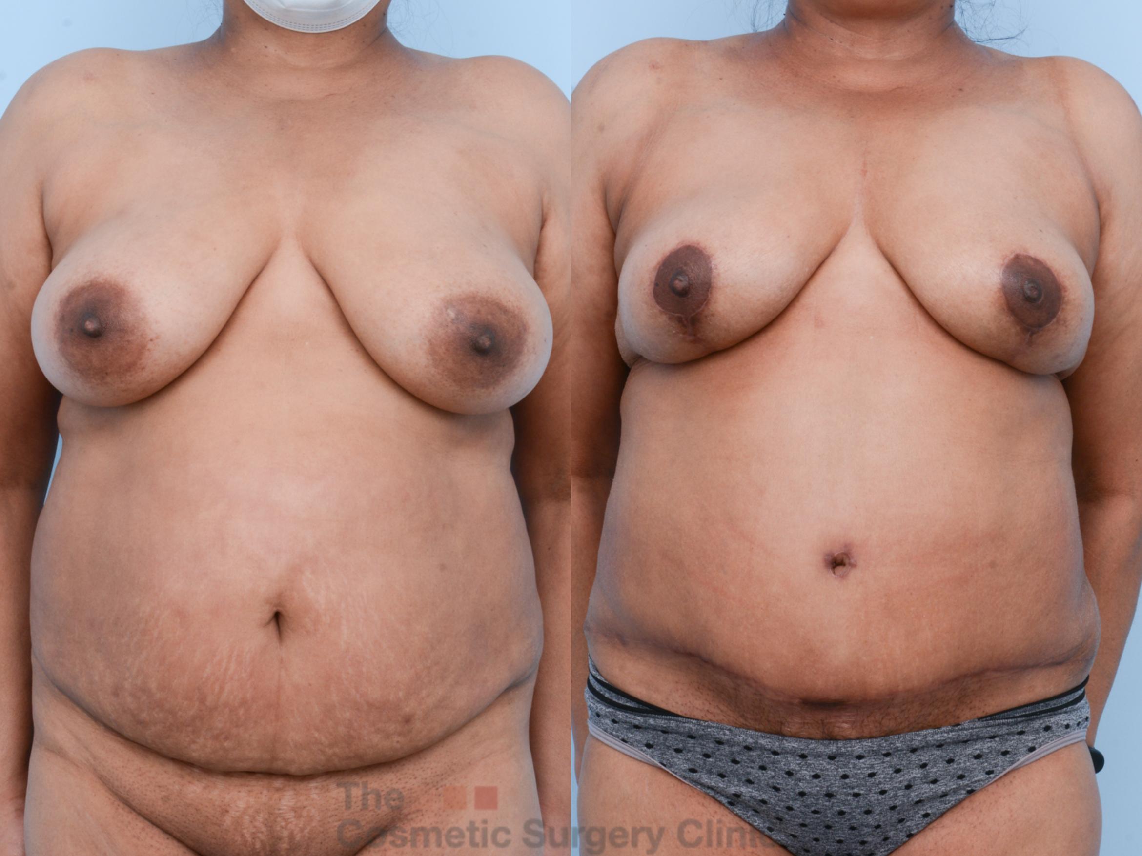 Before & After Mommy Makeover Case 539 View #1 View in Waterloo, Ontario