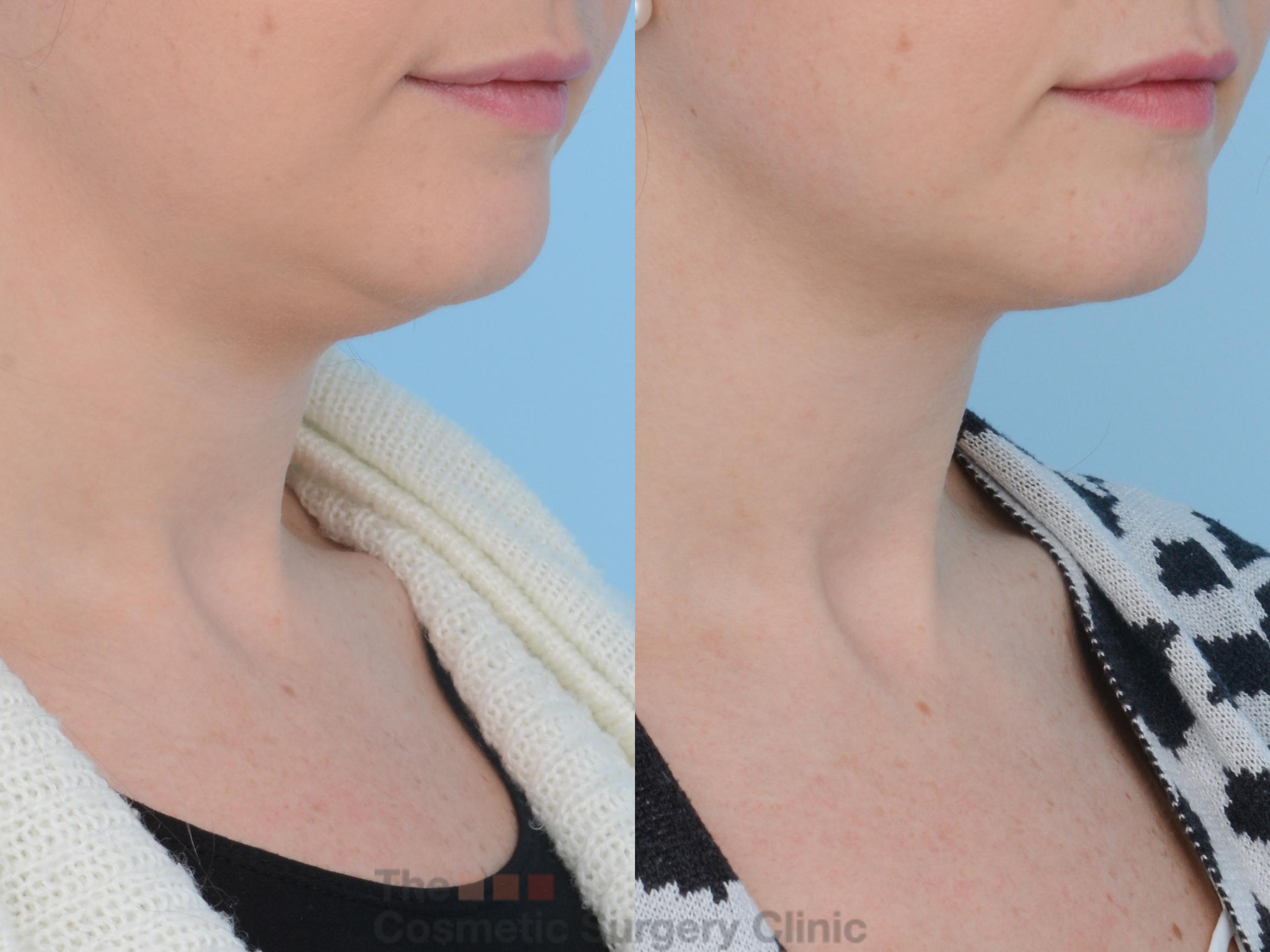 Before & After Non-Surgical Injectables Case 159 View #1 View in Waterloo, Ontario