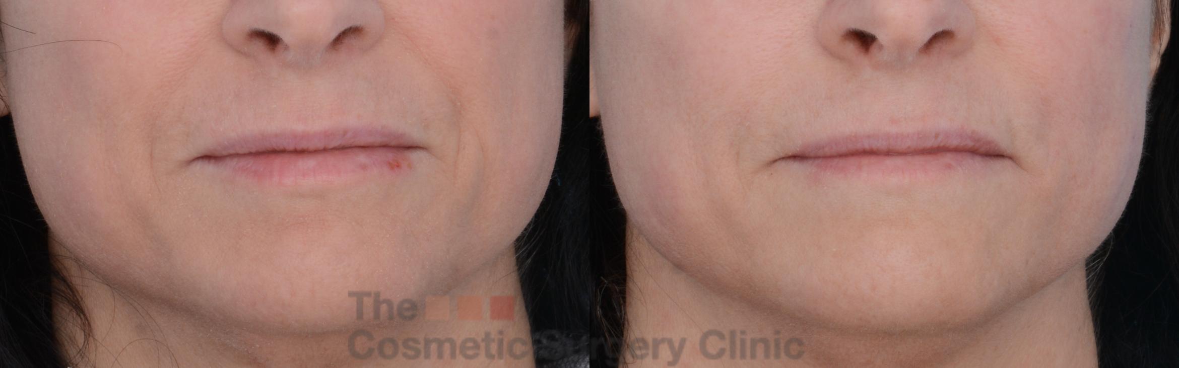 Before & After Non-Surgical Injectables Case 247 View #1 View in Waterloo, Ontario