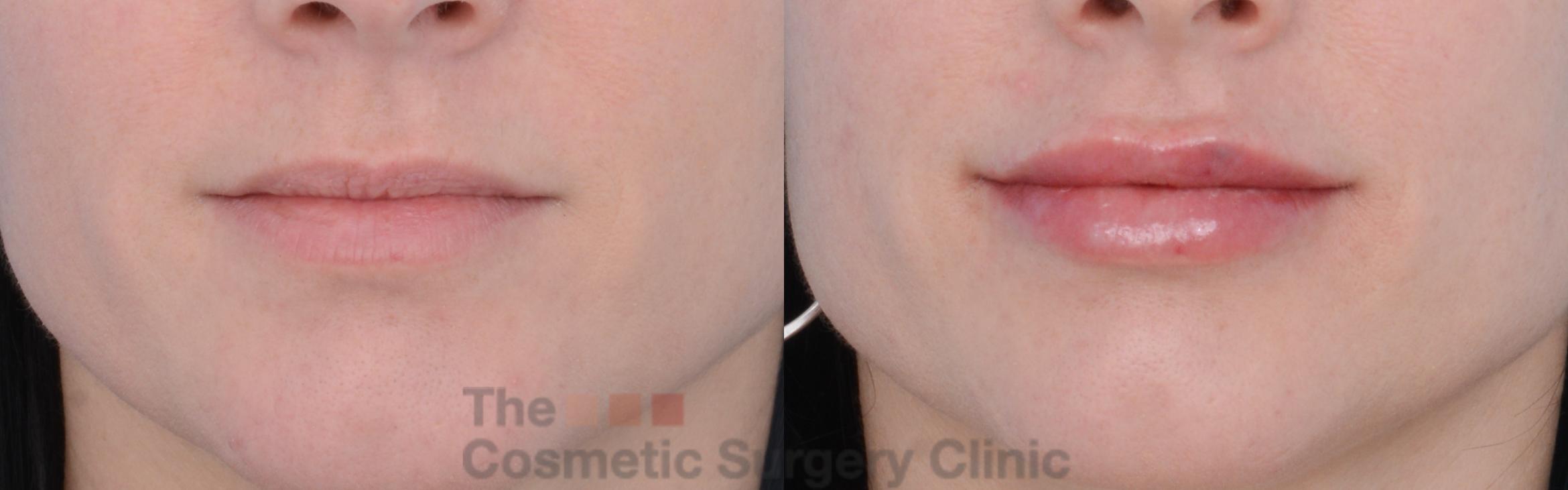 Before & After Non-Surgical Injectables Case 262 View #1 View in Waterloo, Ontario