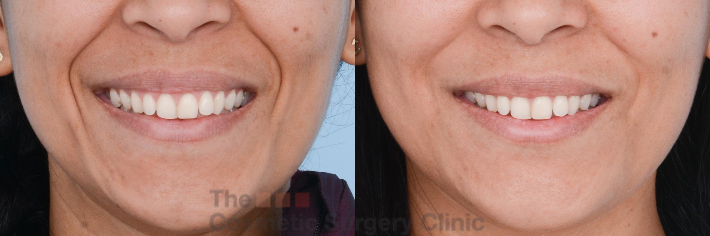 Before & After Non-Surgical Injectables Case 470 View #1 View in Waterloo, Ontario