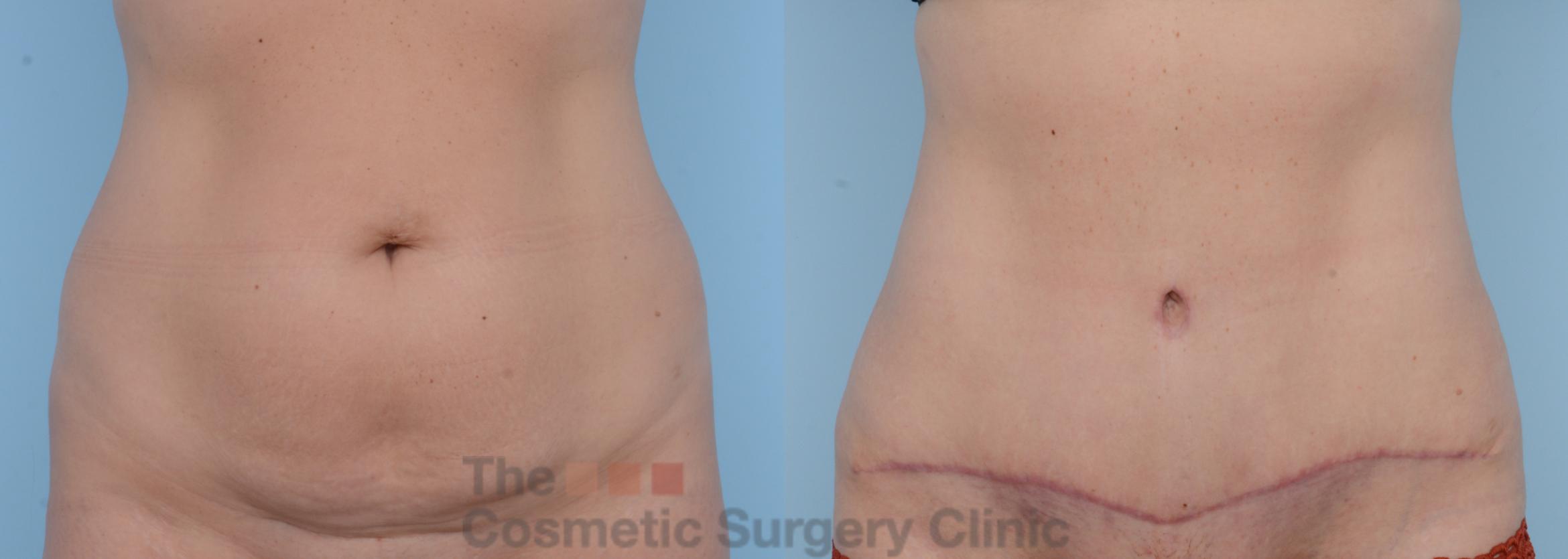 Before & After Tummy Tuck Case 267 View #1 View in Waterloo, Ontario