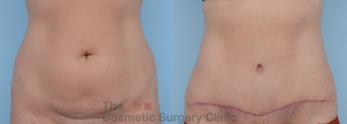 Before & After Tummy Tuck Case 267 View #1 View in Waterloo, Ontario