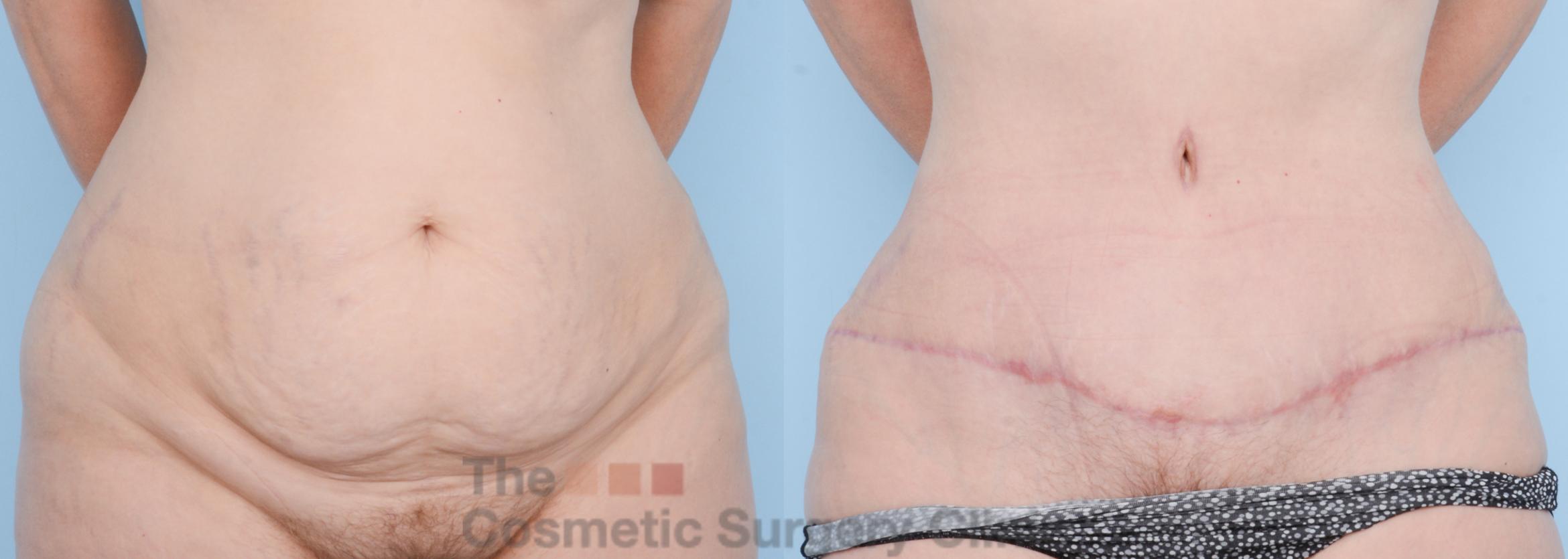 Before & After Tummy Tuck Case 608 View #1 View in Waterloo, Ontario