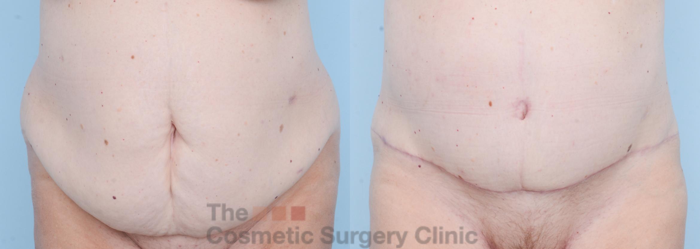 Before & After Tummy Tuck Case 732 Front View in Waterloo, Ontario