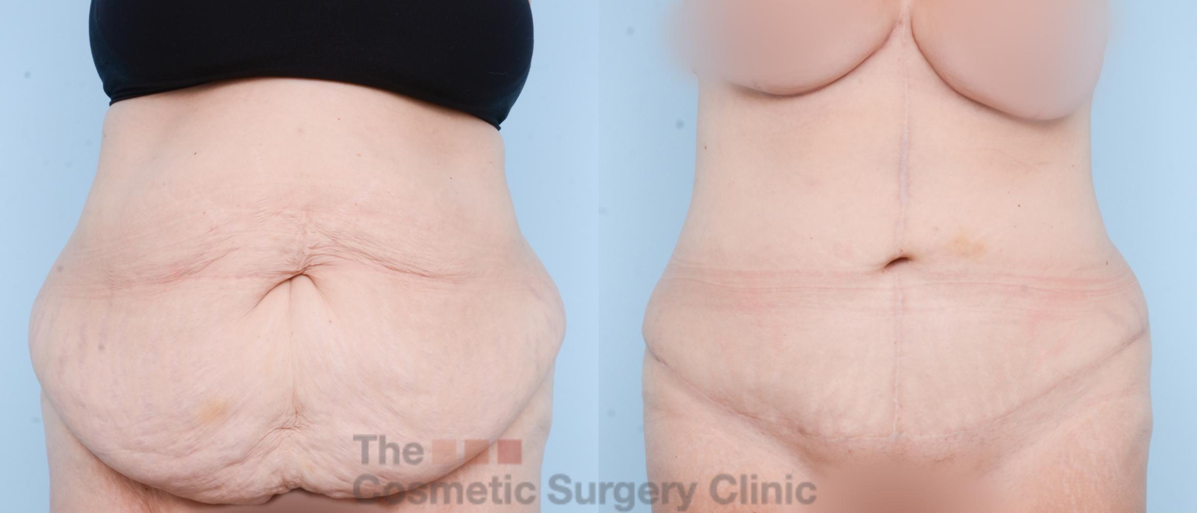 Before & After Tummy Tuck Case 781 Front View in Waterloo, Ontario