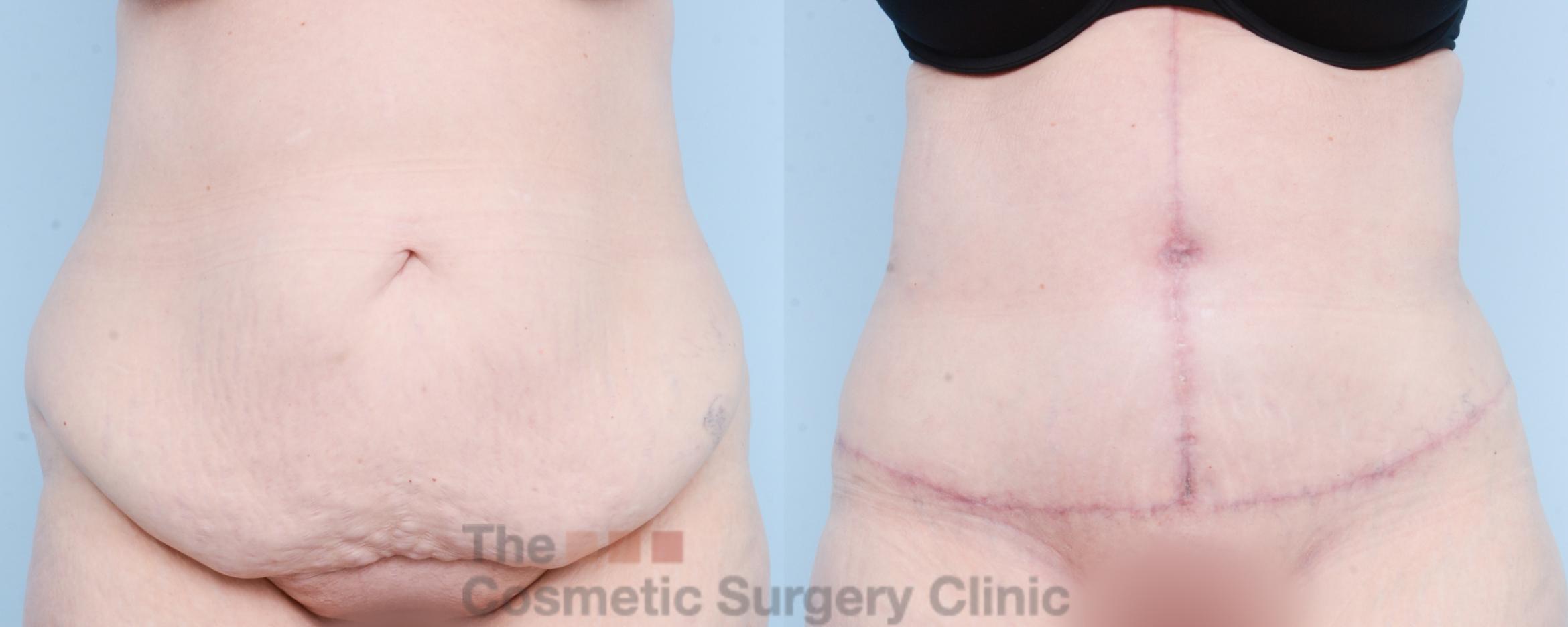 Before & After Tummy Tuck Case 800 Front View in Waterloo, Ontario