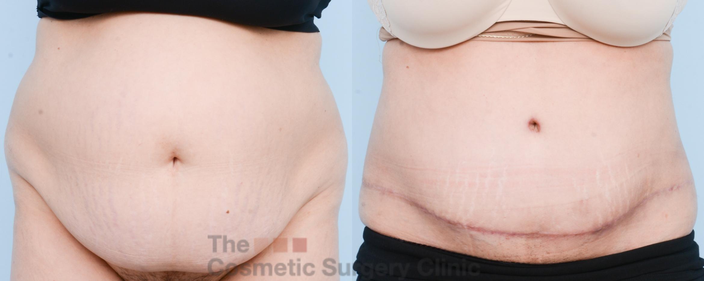 Before & After Tummy Tuck Case 804 Front View in Waterloo, Ontario