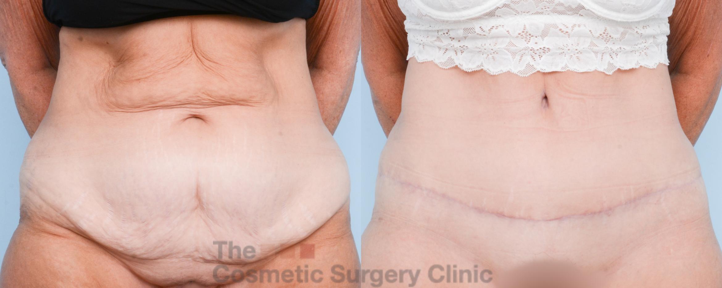 Before & After Tummy Tuck Case 806 Front View in Waterloo, Ontario
