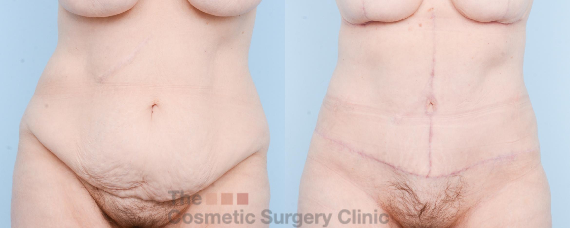 Before & After Tummy Tuck Case 807 Front View in Waterloo, Ontario