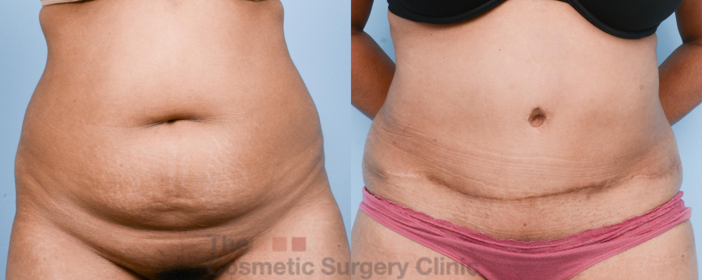 Before & After Tummy Tuck Case 813 Front View in Waterloo, Ontario